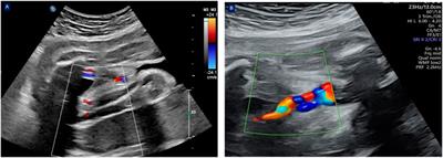 Expectant management for umbilical artery thrombosis in the third trimester of pregnancy: a case report